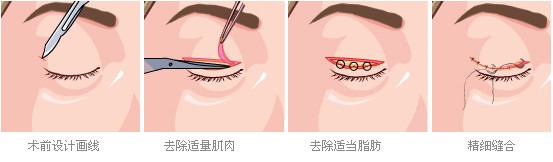 北京丹熙整形美容医院双眼皮失败修复术图示 北京丹熙整形美容医院双眼皮失败修复术图示