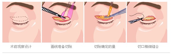 北京丹熙整形美容医院上眼皮下垂修复手术示意图 北京丹熙整形美容医院上眼皮下垂修复手术示意图