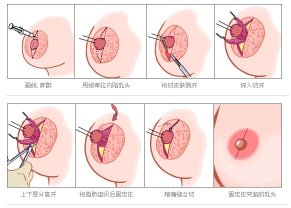 北京丹熙整形美容医院乳头内陷矫正术 北京丹熙整形美容医院乳头内陷矫正术