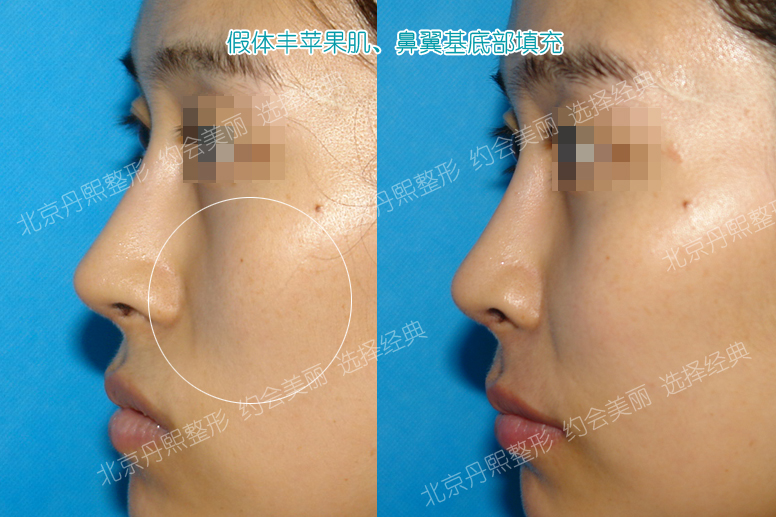 北京丹熙整形美容医院假体丰苹果肌对比案例 北京丹熙整形美容医院假体丰苹果肌对比案例