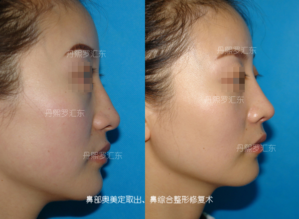 北京丹熙美容整形医院鼻部奥美定取出鼻综合整形修复术对比案例 北京丹熙美容整形医院鼻部奥美定取出鼻综合整形修复术对比案例
