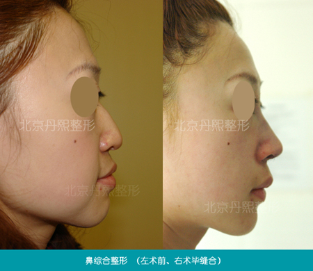 北京丹熙美容整形医院鼻小柱整形术鼻小柱修复术案例 北京丹熙美容整形医院鼻小柱整形术鼻小柱修复术案例