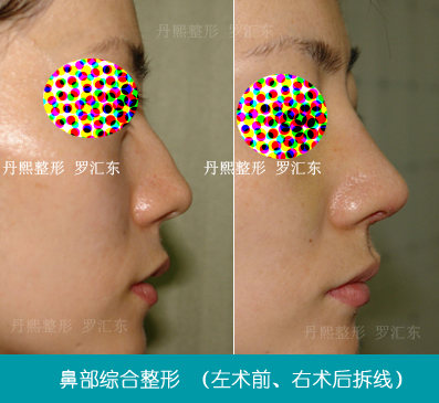 北京丹熙美容整形医院驼峰鼻矫正术术前术后对比案例 北京丹熙美容整形医院驼峰鼻矫正术术前术后对比案例