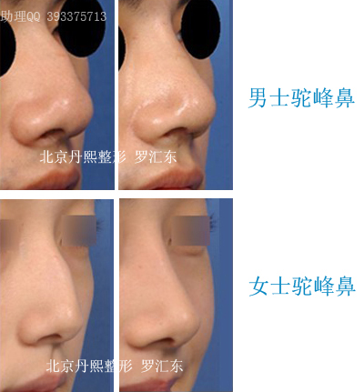 北京丹熙美容整形医院驼峰鼻矫正术术前术后对比 北京丹熙美容整形医院驼峰鼻矫正术术前术后对比