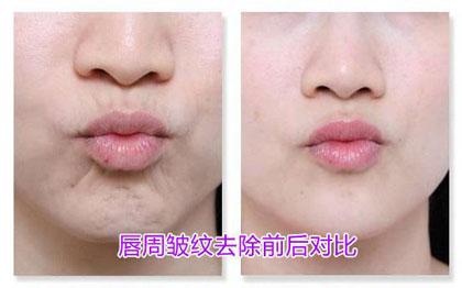 口周纹(嘴角纹)